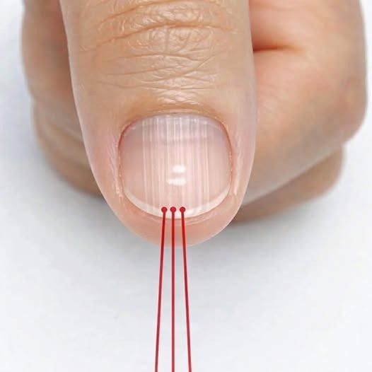 ¡Si tienes rayas en las uñas significa que tienes can… Ver más